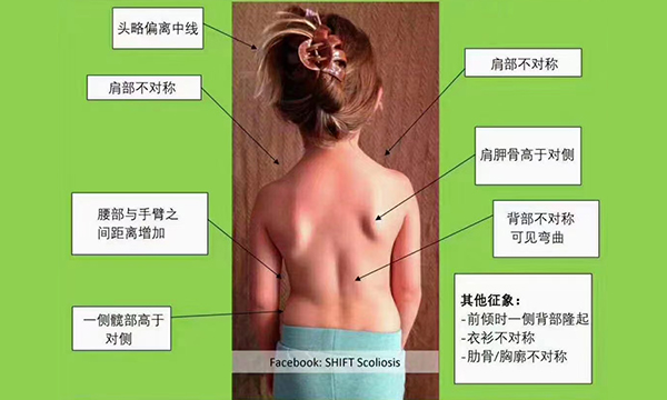 如何早期發(fā)現(xiàn)脊柱畸形和脊柱側(cè)彎