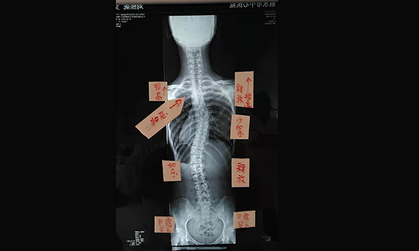 什么是脊柱畸形和脊柱側(cè)彎