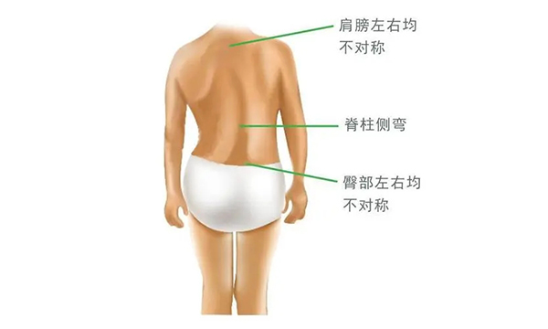 什么是脊柱側(cè)彎？